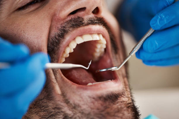 Best Knocked-Out Tooth (Avulsed Tooth) Treatment in USA
